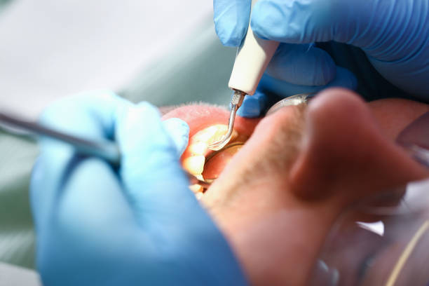 Best Emergency Dental Care for Abscessed Tooth in Madisonville, KY